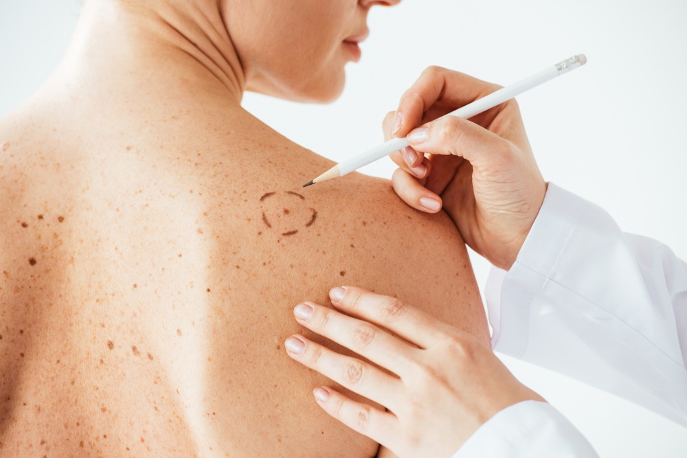 Conheça os tipos de melanoma