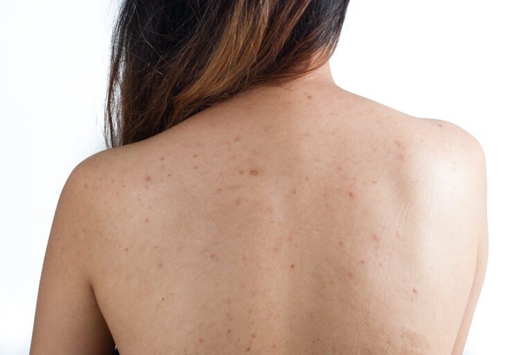 Costas de mulher com muitas pintas