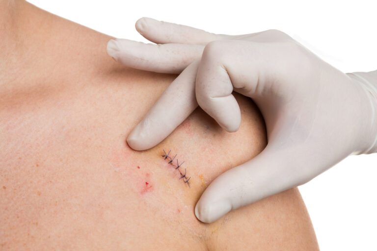 Cirurgia de Câncer de Pele - Médico examinando cicatrização na pele do paciente