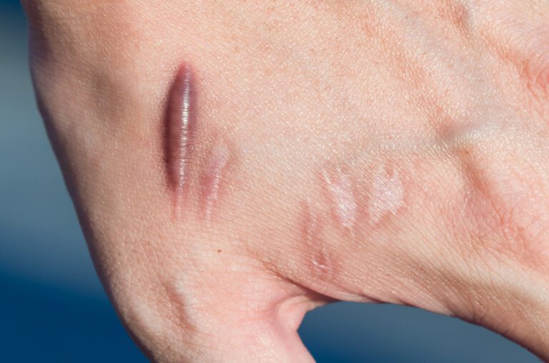 Cicatriz de queloide em uma mão - tratamentos para queloide