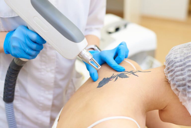 Paciente passando por processo de remoção de tatuagem antes e depois