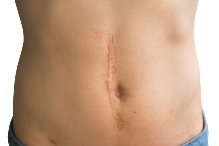Cicatriz hipertrófica na barriga de um homem