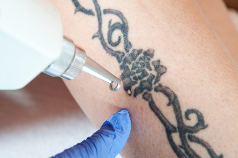 Aparelho de laser em cima de tatuagem