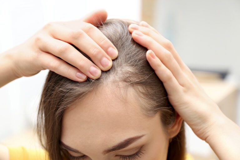Mulher com calvície feminina mostra a raiz do cabelo