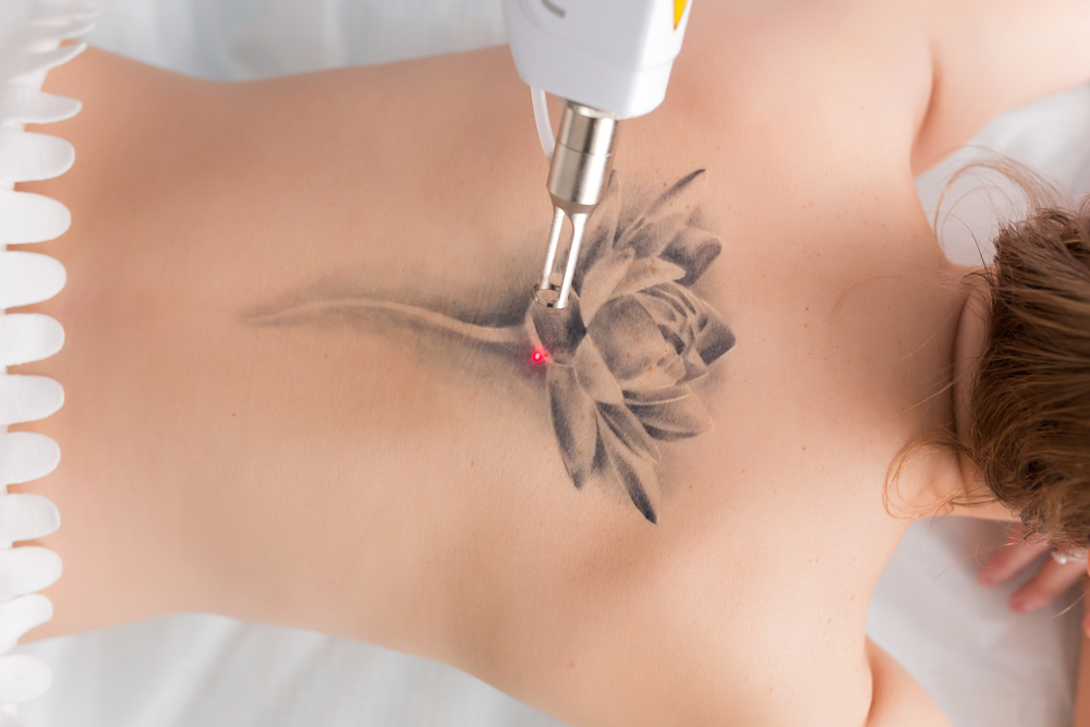 Como fica a pele depois de remover tatuagem?