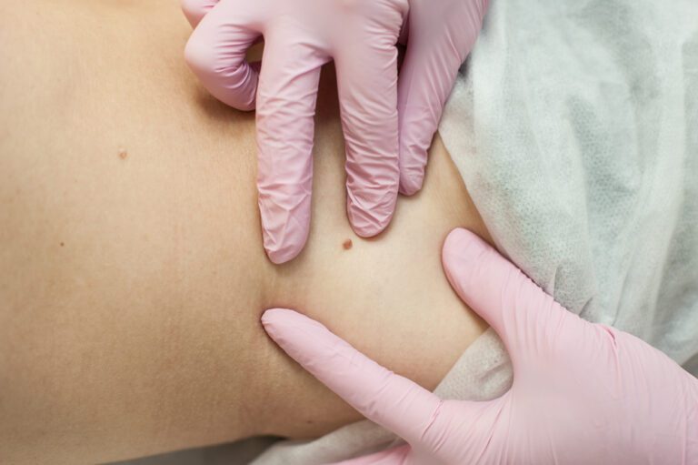 Dermatologista retirando verruga
