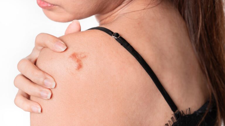 Queiloide ou granuloma