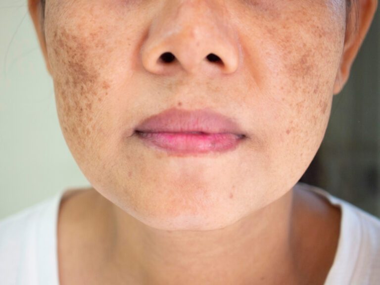 Imagem ilustrativa do melasma