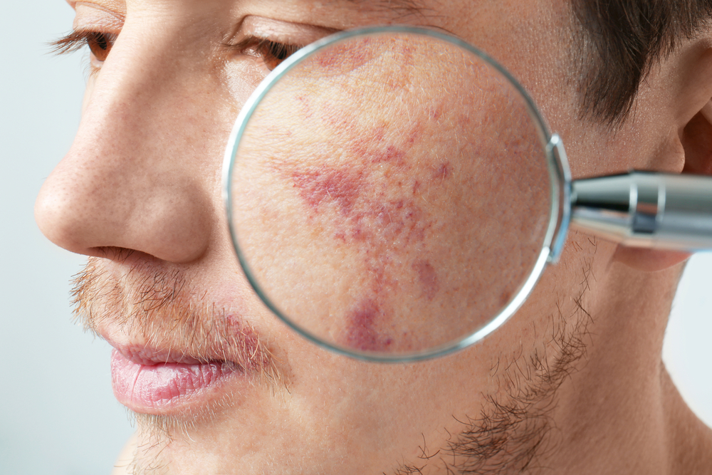 Conheça todos os tipos de acne