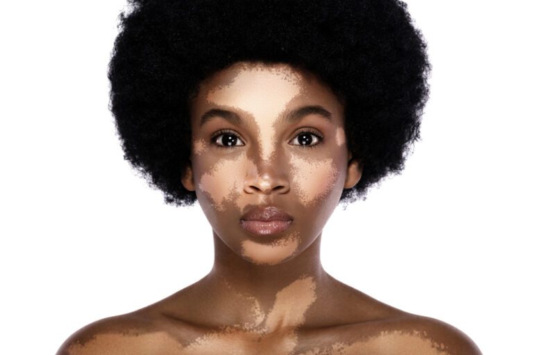 imagem de uma mulher com vitiligo