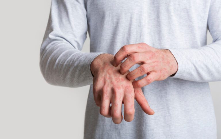 Imagem ilustrativa de manchas vermelhas no corpo