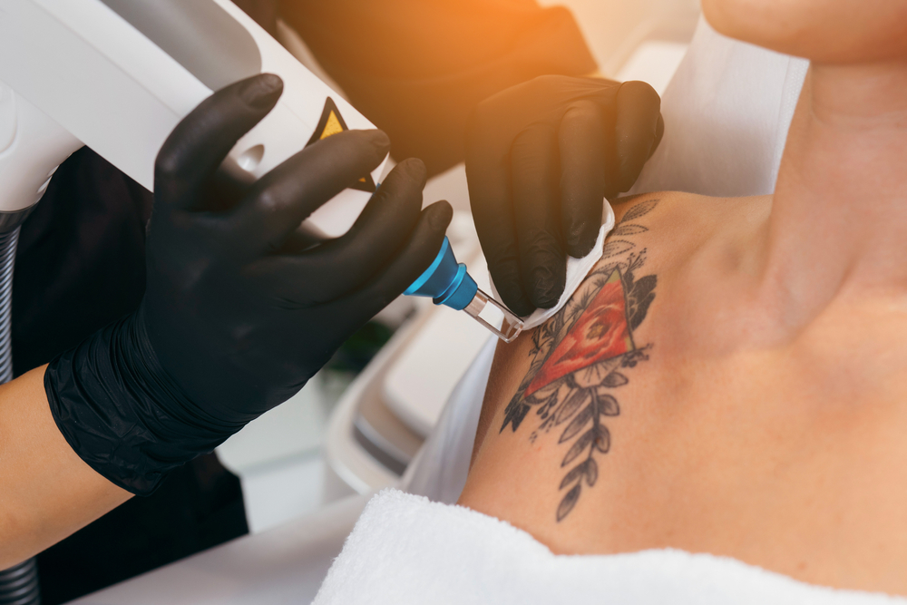Tatuagens novas e coloridas podem ser removidas?