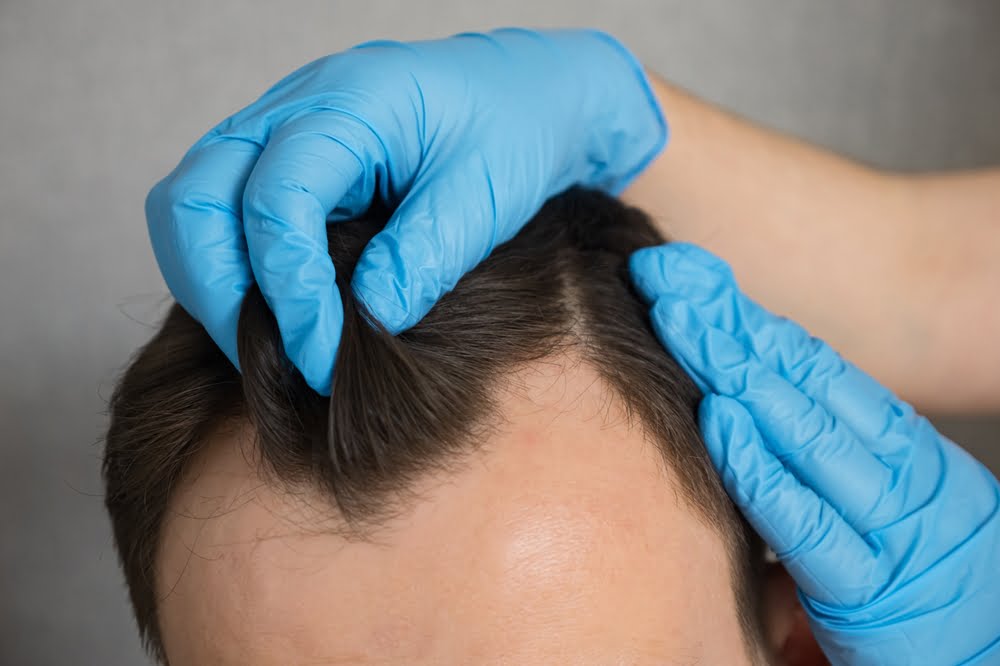 Calvície masculina: Causas e tratamentos