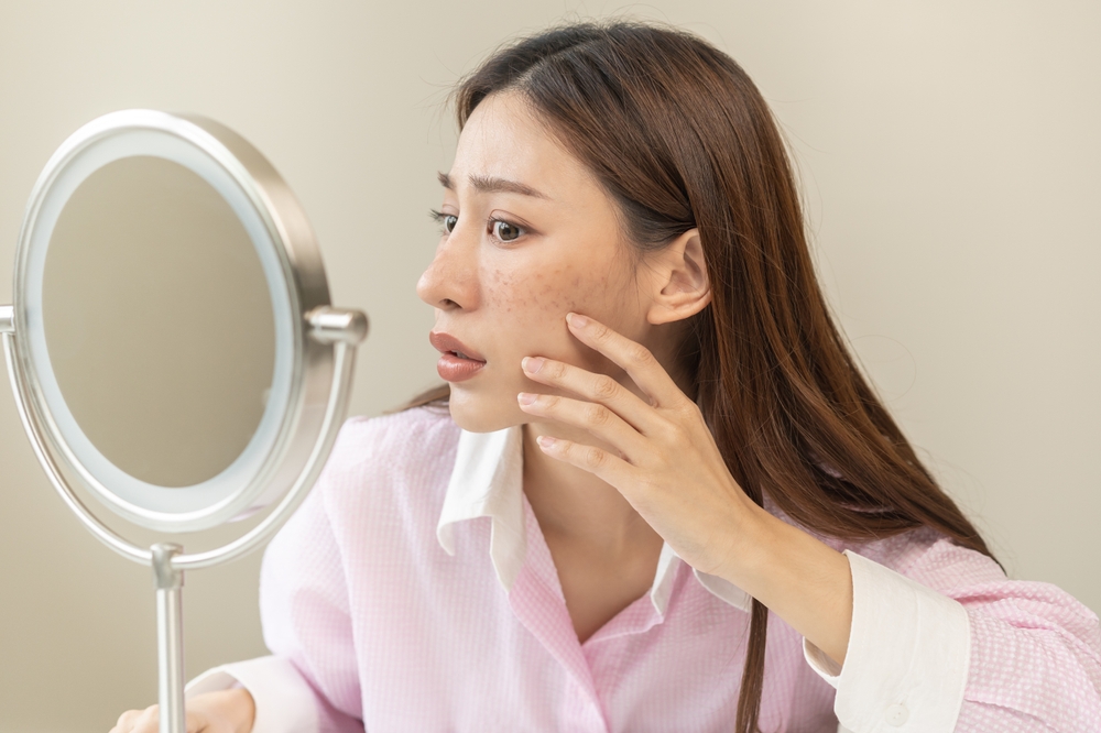 Quais os tratamentos para o melasma?