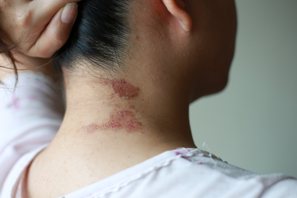 Causas da dermatite de contato