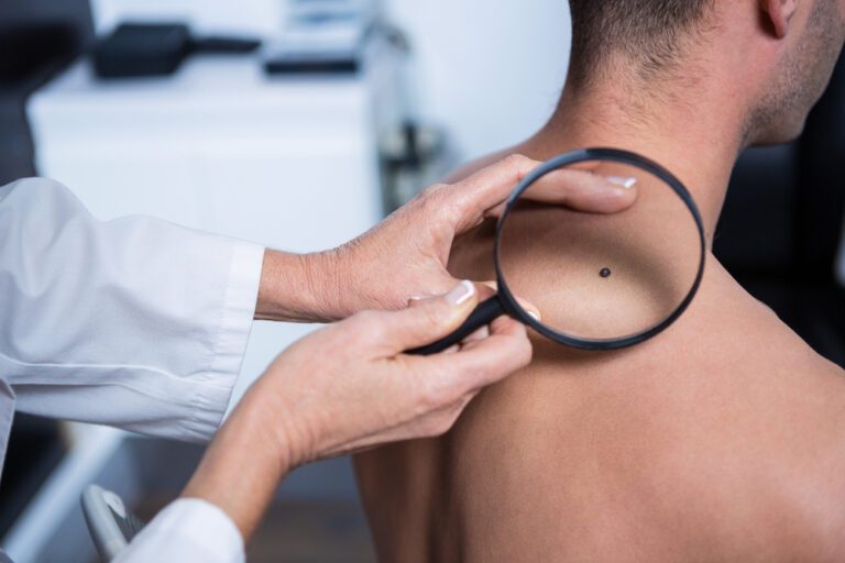 Imagem ilustrativa de um médico olhando um melanoma, com a lupa, no ombro de um homem