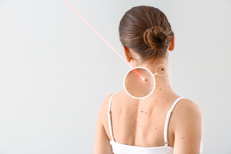 Mulher sendo submetida a procedimento de remoção de verruga nas costas por laser