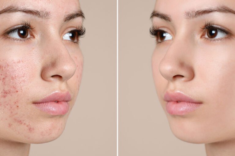 Imagem ilustrativa do antes e depois do tratamento para acne