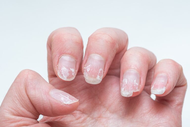 Imagem ilustrativa de unhas fragilizadas