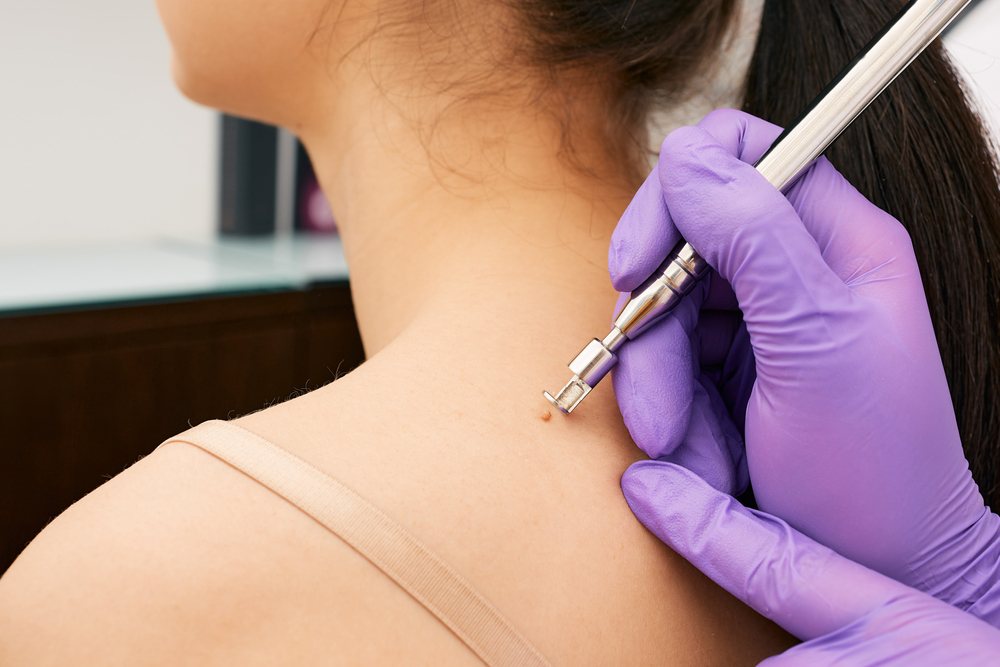 Cirurgia para retirar pintas: como é feita e quando é indicada?