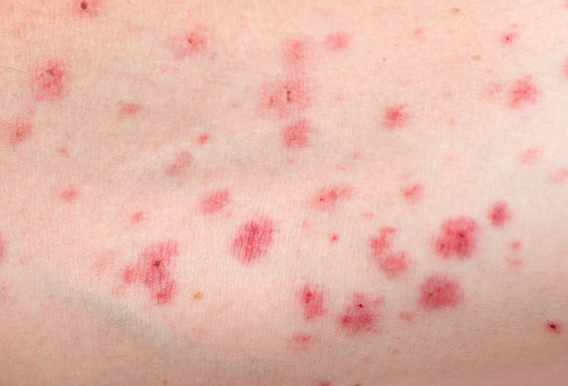 Pintas vermelhas na pele: O que pode ser?