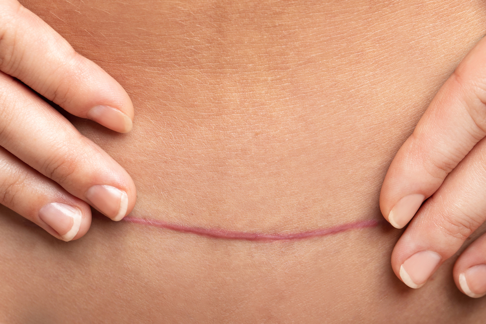 Dermatologista especialista em cicatriz: saiba tudo sobre esse profissional!