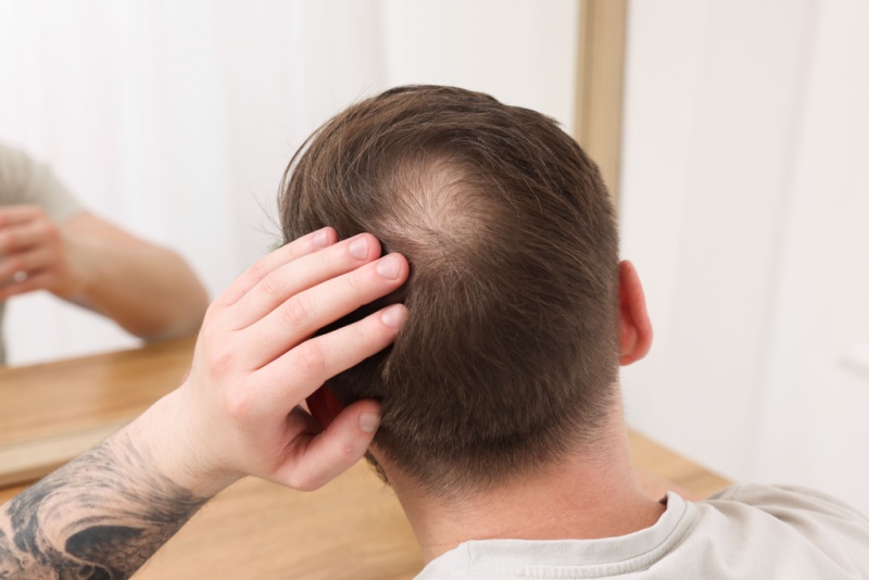 Calvice tem cura? Conheça os melhores tratamentos para essa condição