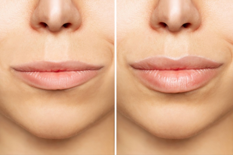 Como é o antes e depois do preenchimento labial?