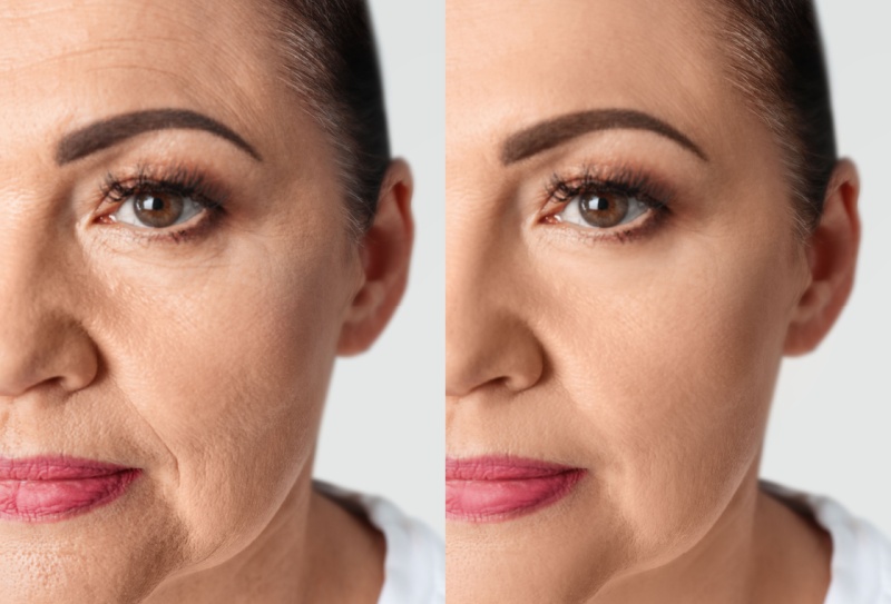 Como é o antes e depois do bioestimulador de colágeno?