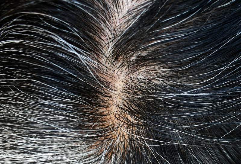 Eflúvio telógeno: sintomas, causas e tratamentos