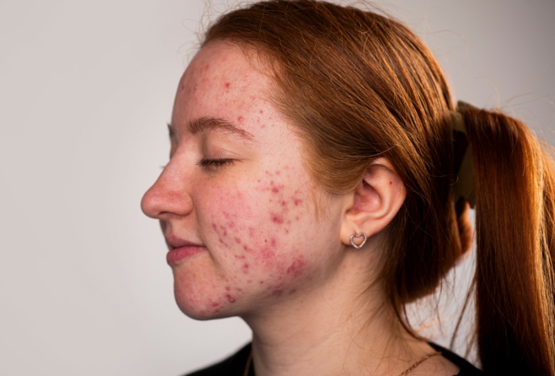 Acne hormonal: causas e tratamento