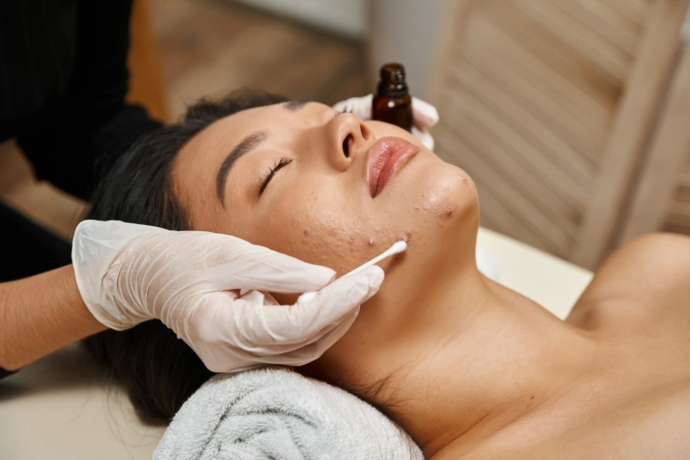 Quanto custa tratar a acne?