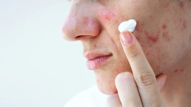 mulher passando pomada para acne no rosto